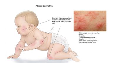 Sekilas Tentang Dermatitis Atopik